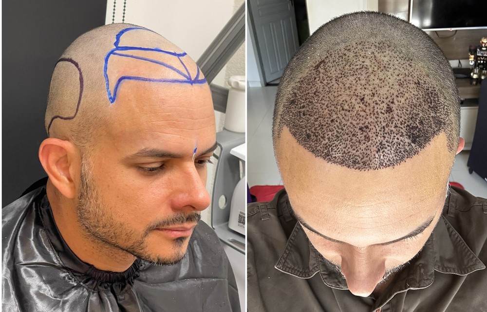 US residents seek hair transplant in Brazil